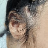 Scalp condition after - Meera Joshi