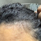 Scalp condition after - Siddharth Roy