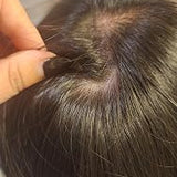 Scalp condition after - Varun Kapoor