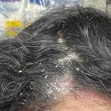 Scalp condition after - Ritu Bhatia