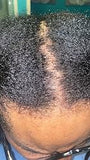 Scalp condition after - Nikhil Saxena