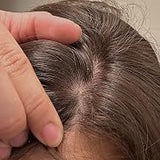 Scalp condition after - Manisha Chopra