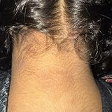 Scalp condition after - Anisha Patel