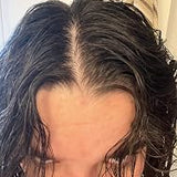 Scalp condition after - Ananya Iyer