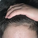 Scalp condition after - Sneha Kulkarni