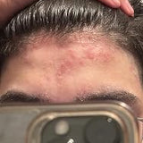 Scalp condition after - Vikram Malhotra