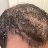 Scalp condition after - Parth Deshmukh