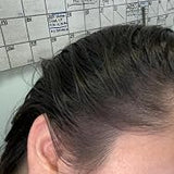Scalp condition after - Aditi Verma