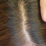 Scalp condition after - Divya Nair