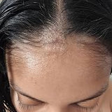 Scalp condition before - Meera Joshi