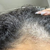 Scalp condition before - Siddharth Roy