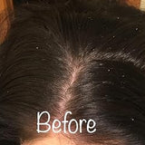 Scalp condition before - Kavita Nambiar