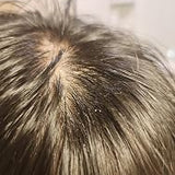 Scalp condition before - Varun Kapoor
