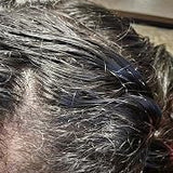 Scalp condition before - Ritu Bhatia