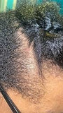 Scalp condition before - Nikhil Saxena