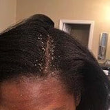Scalp condition before - Ishita Banerjee