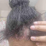 Scalp condition before - Priya Sharma