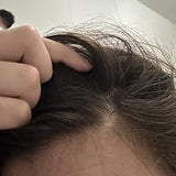 Scalp condition before - Manisha Chopra