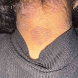 Scalp condition before - Anisha Patel