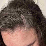Scalp condition before - Ananya Iyer