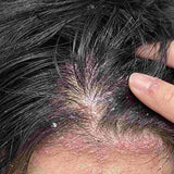 Scalp condition before - Sneha Kulkarni