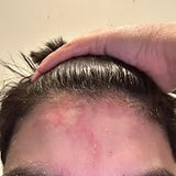 Scalp condition before - Vikram Malhotra