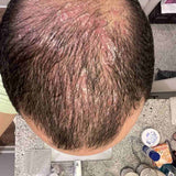 Scalp condition before - Parth Deshmukh