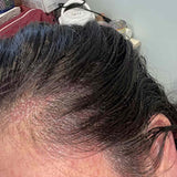 Scalp condition before - Aditi Verma
