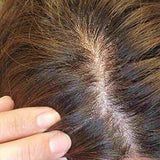 Scalp condition before - Divya Nair